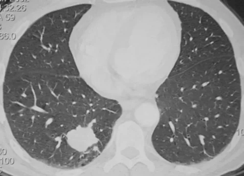 Nodule pulmonaire