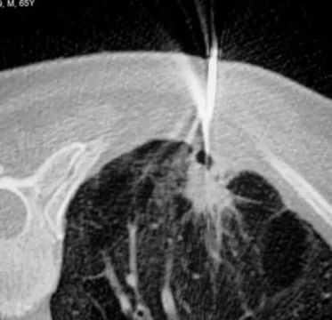 Ponction sous scanner vue TDM