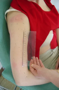 Tests cutanés allergiques