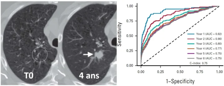L’IA appliquée au scanner thoracique peut aider à prédire l’apparition du cancer du poumon.
