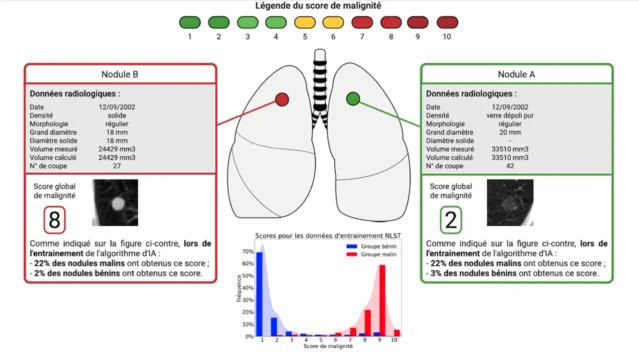 L’IA peut aider à la caractérisation de la malignité d'un nodule.