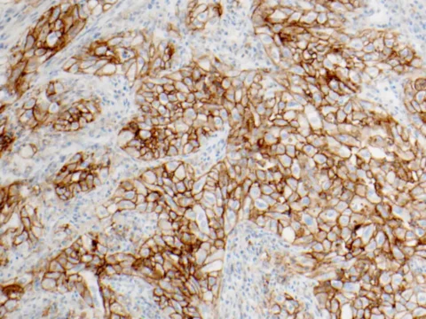 Caractérisation immunologique d'un nodule découvert sur un scanner de dépistage.