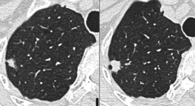 Nodule pulmonaire dont la croissance oriente vers sa nature maligne.