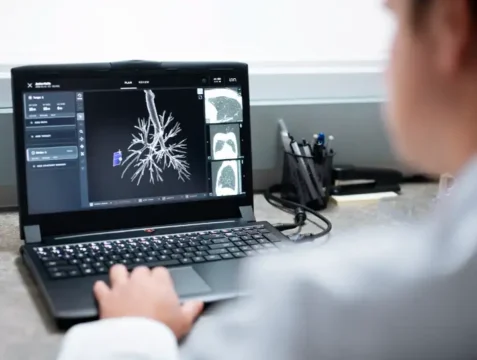 Planification de la navigation endoscopique robotisée afin d’accéder au diagnostic d’un nodule pulmonaire.