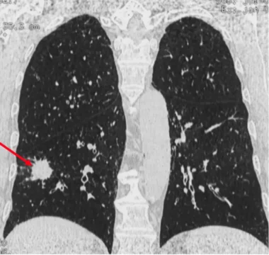 Nodule suspect (probable cancer à un stade précoce découvert sur un scanner de dépistage)