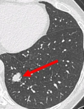 Nodule suspect (probable cancer à un stade précoce découvert sur un scanner de dépistage)